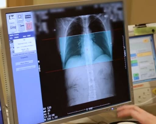 Coronary Artery Calcium Scoring Cacs Warns Of Heart Disease Risk