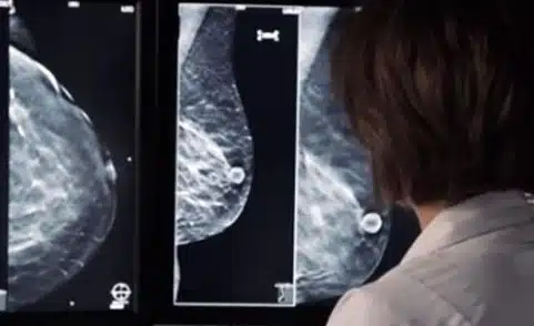 4 Things to do if you get “the call” after a Mammogram