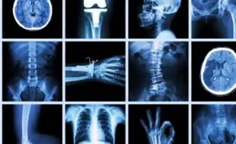 What You Need to Know Before You Get an X-ray