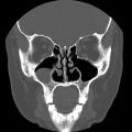 CT images of nose