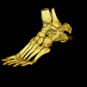 CT of the Foot with 3-D Reconstruction