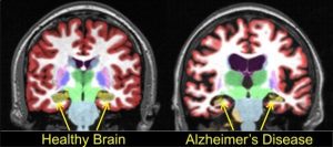 Healthy brain vs Alzheimer's brain