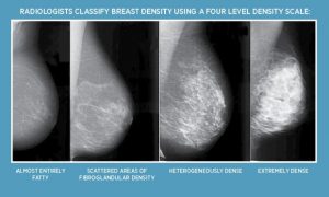 Breast Density Scale