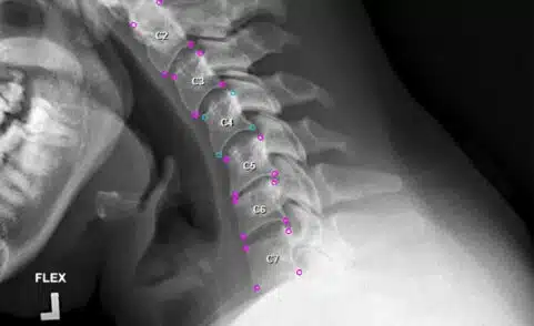 RAYUS Radiology and Medical Metrics Diagnostics, Inc. (MMDx) Announce Strategic Partnership to Expand Access to AI-Powered, FDA-Cleared Spine Analytics in Utah